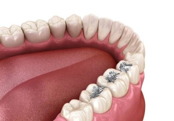 Amalgámové výplne končia